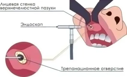 Видалення кісти пазух носа види операцій, особливості (видалення) Видалення кісти пазух носа види операцій, особливості