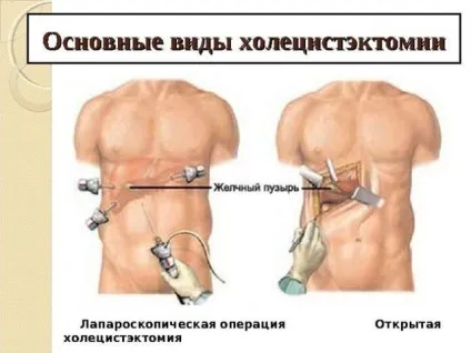 Видалення жовчного міхура наслідки і спосіб життя (образ) Видалення жовчного міхура наслідки і спосіб життя