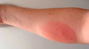 Укус мошки - чим помазати