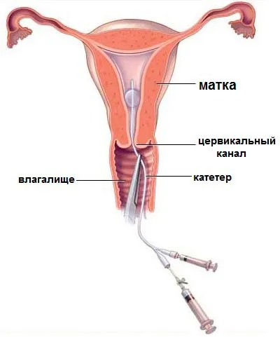 Ультрасонографія маткових труб Київ - міський центр медичних досліджень (прохідність маткових труб) Ультрасонографія маткових труб Київ - міський центр медичних досліджень