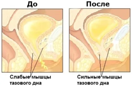 Вправи Кегеля для чоловіків, жінок, вправи Кегеля для вагітних (чоловіків) Вправи Кегеля для чоловіків, жінок, вправи Кегеля для вагітних