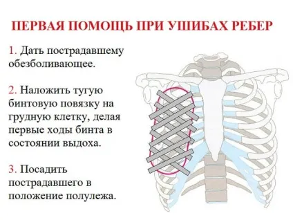 Забій ребер, як лікувати сильний удар при падінні (сильний) Забій ребер, як лікувати сильний удар при падінні