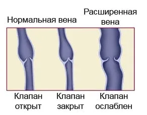 Варикозне розширення вен симптоми, діагностика, лікування (варикозне розширення вен симптоми) Варикозне розширення вен симптоми, діагностика, лікування