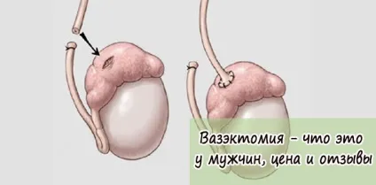 Вазектомія - що це у чоловіків, ціна та відгуки (вазектомія) Вазектомія - що це у чоловіків, ціна та відгуки