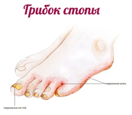 Ванночки від грибка стопи в домашніх умовах (умовах) Ванночки від грибка стопи в домашніх умовах