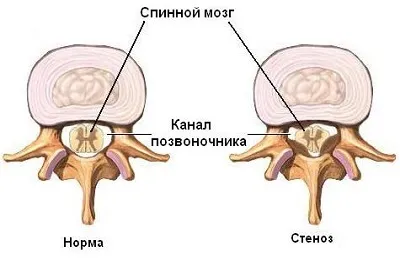 Звуження судин шийного відділу позвоніочніка симптоми і причини стенозу (звуження) Звуження судин шийного відділу позвоніочніка симптоми і причини стенозу