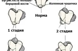Вивих коліна лікування і реабілітація (коліна) Вивих коліна лікування і реабілітація