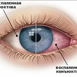 Шкода контактних лінз