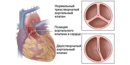 Вроджена вада серця у новонароджених дітей причини і класифікація (порок) Вроджена вада серця у новонароджених дітей причини і класифікація