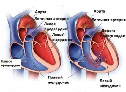 Вроджена вада серця у новонароджених дітей причини і класифікація (вроджені вади серця у дітей) Вроджена вада серця у новонароджених дітей причини і класифікація
