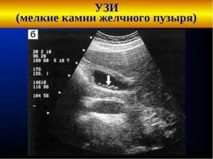 Холестеринові камені в жовчному міхурі симптоми і лікування (міхурі) Холестеринові камені в жовчному міхурі симптоми і лікування