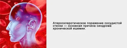 Хронічна ішемія головного мозку що це таке, симптоми і лікування (мозку) Хронічна ішемія головного мозку що це таке, симптоми і лікування