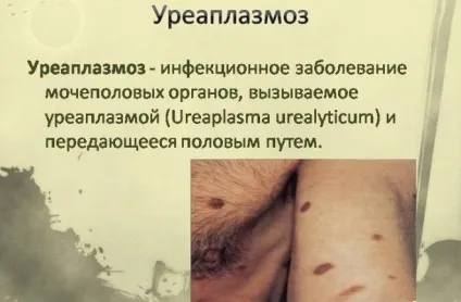 Хламідіоз, мікоплазмоз, уреаплазмоз симптоми і лікування - живи здорово