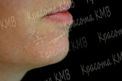 хімічний пілінг