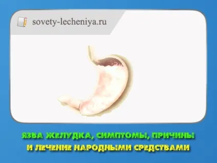 Виразка шлунка, симптоми, причини і лікування народними засобами (причини) Виразка шлунка, симптоми, причини і лікування народними засобами