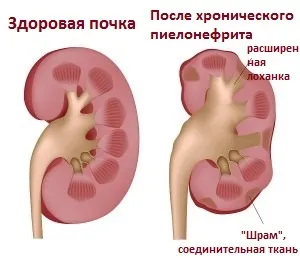 Застуджені нирки симптоми і лікування (ліки) Застуджені нирки симптоми і лікування
