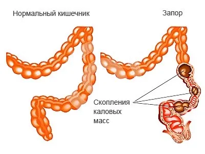 Запор перед місячними чому виникає, основні причини запору і здуття (запор) Запор перед місячними чому виникає, основні причини запору і здуття