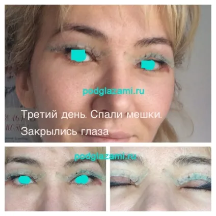 Жирова грижа під очима лікування без операції народними засобами (блефаропластика) Жирова грижа під очима лікування без операції народними засобами