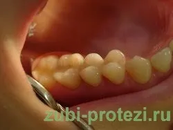 Зубні коронки із металопласмаси термін служби, етапи установки, вартість 4 500р (зубні) Зубні коронки із металопласмаси термін служби, етапи установки, вартість 4 500р