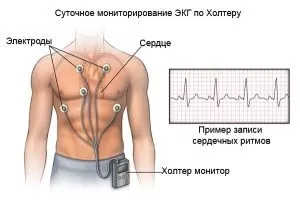 Тахікардія у підлітків причини, як виявляється (тахікардія) Тахікардія у підлітків причини, як виявляється