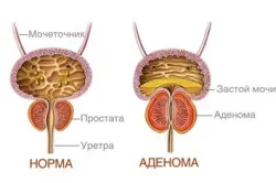 Аденома нирки діагностування та методи лікування (нирки) Аденома нирки діагностування та методи лікування