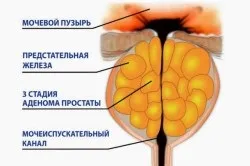 Аденокарцинома передміхурової залози і її лікування (аденокарцинома передміхурової залози простати мелкоацінарная лікування) Аденокарцинома передміхурової залози і її лікування