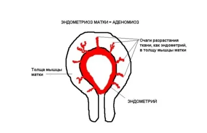Аденоміоз матки що це таке, симптоми і ознаки, як проводиться лікування препаратами та народними (таке) Аденоміоз матки що це таке, симптоми і ознаки, як проводиться лікування препаратами та народними