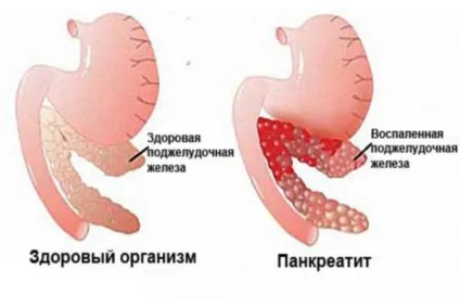 Алкогольний панкреатит гострої і хронічної форми симптоми, лікування, прогнози (хронічний панкреатит алкогольної етіології) Алкогольний панкреатит гострої і хронічної форми симптоми, лікування, прогнози