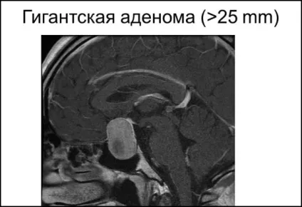Аденома гіпофіза головного мозку - що це таке (аденома) Аденома гіпофіза головного мозку - що це таке