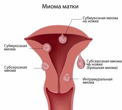 Аденоміоз матки що це таке, симптоми і ознаки, як проводиться лікування препаратами та народними (матки) Аденоміоз матки що це таке, симптоми і ознаки, як проводиться лікування препаратами та народними