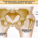 Асептичний некроз головки стегнової кістки причини, симптоми і лікування (некроз) Асептичний некроз головки стегнової кістки причини, симптоми і лікування