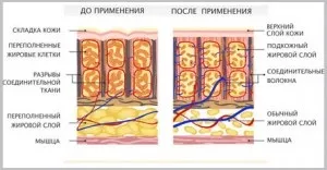 Апарат для вакуумно-роликового масажу фото, протипоказання (апарат) Апарат для вакуумно-роликового масажу фото, протипоказання