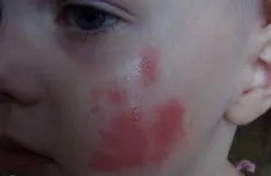 Алергія на фікус, алергія