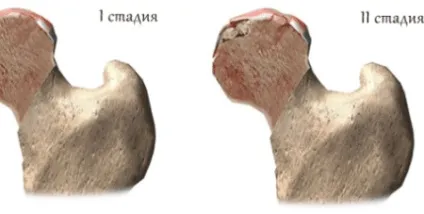 Асептичний некроз головки стегнової кістки причини, симптоми і лікування (асептичний некроз головки стегнової кістки) Асептичний некроз головки стегнової кістки причини, симптоми і лікування