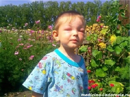 Алергія на укус бджоли у дітей, симптоми, лікування (дітей) Алергія на укус бджоли у дітей, симптоми, лікування
