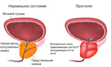 БАДи від простатиту цілющий ефект і перелік препаратів (ефект) БАДи від простатиту цілющий ефект і перелік препаратів
