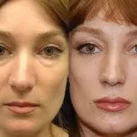 Блефаропластика зняття швів - верхніх повік, коли (зняття) Блефаропластика зняття швів - верхніх повік, коли