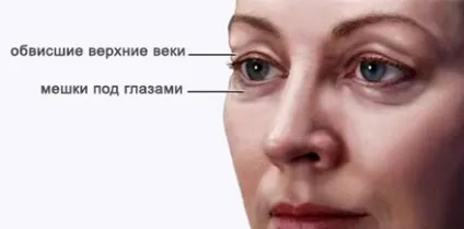 Безопераційна блефаропластика верхніх і нижніх повік відгуки, фото до і після, ціни (безопераційна) Безопераційна блефаропластика верхніх і нижніх повік відгуки, фото до і після, ціни