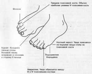 Болять пальці ніг і подушка під ними методи лікування і профілактики