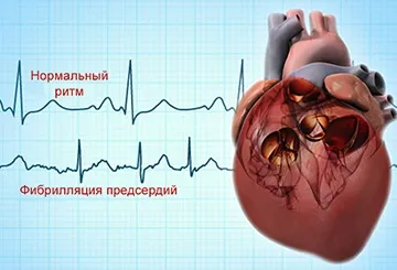 Хвороба Альцгеймера - чи передається у спадок (альцгеймера) Хвороба Альцгеймера - чи передається у спадок