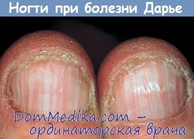 Хвороба Дарині - діагностика, лікування (лікування) Хвороба Дарині - діагностика, лікування