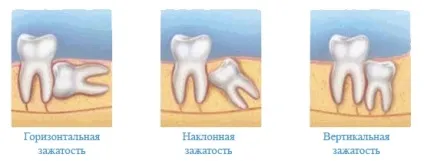 Брекети і зуби мудрості