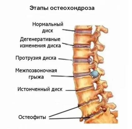 Болять ноги що робити в домашніх умовах, м'язи, вени і при вагітності (ноги) Болять ноги що робити в домашніх умовах, м'язи, вени і при вагітності