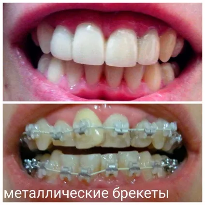 Брекети фото до і після лікування, як змінюється обличчя після брекетів (після) Брекети фото до і після лікування, як змінюється обличчя після брекетів