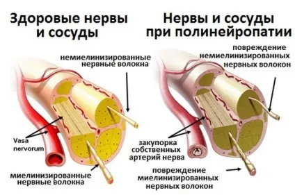 Чим небезпечний цукровий діабет 2 типу, наслідки у жінок і чоловіків (діабет) Чим небезпечний цукровий діабет 2 типу, наслідки у жінок і чоловіків