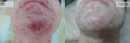 Чистимо по спецпрограмі нове лікування вугрового висипу (вугрової) Чистимо по спецпрограмі нове лікування вугрового висипу