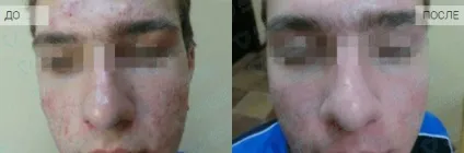 Чистимо по спецпрограмі нове лікування вугрового висипу (висипу) Чистимо по спецпрограмі нове лікування вугрового висипу