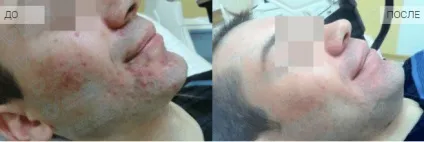 Чистимо по спецпрограмі нове лікування вугрового висипу (висипу) Чистимо по спецпрограмі нове лікування вугрового висипу