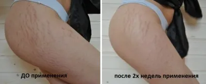 Чиста шкіра за 2 місяці я розповім вам як позбутися від розтяжок назавжди! (Позбутися) Чиста шкіра за 2 місяці я розповім вам як позбутися від розтяжок назавжди!