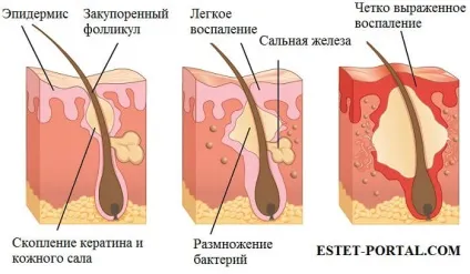 Чистимо по спецпрограмі нове лікування вугрового висипу (лікування) Чистимо по спецпрограмі нове лікування вугрового висипу